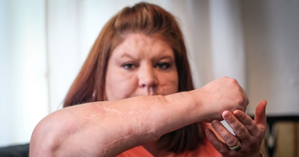 Woman who almost lost her arm in dog attack calls for a change in the law